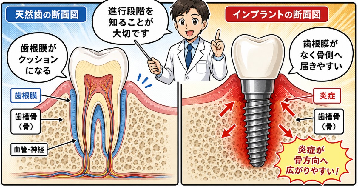 インプラント周囲炎とは？天然歯の歯周病との違いと進行の仕組み