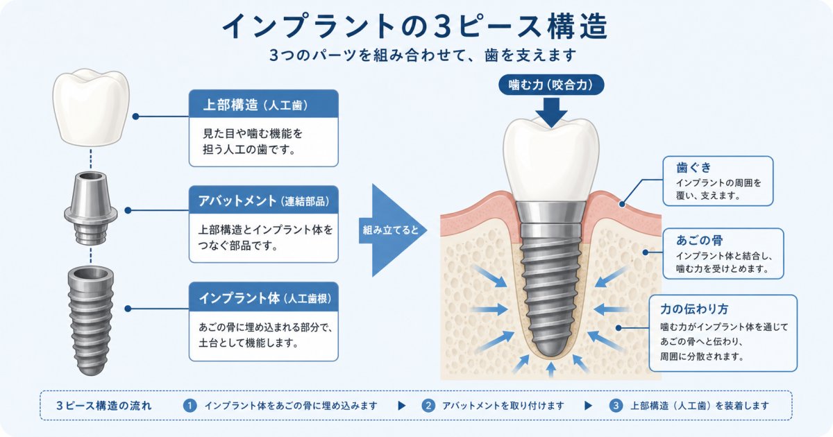 強い咀嚼圧を受け止めるインプラントの3ピース構造と役割