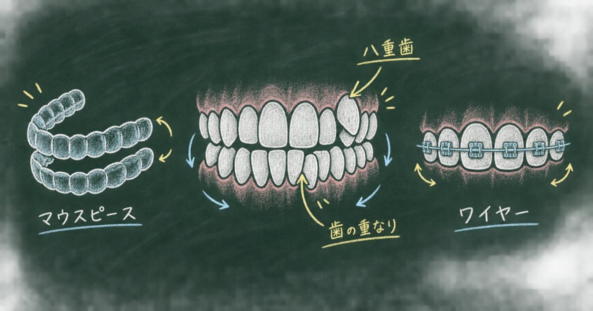 大人の八重歯・ガタガタは今からでも矯正できる?原因と治療法